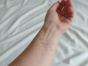 16 casos confirmados de sarampión en Puebla